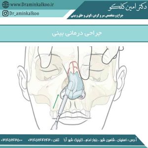 جراحی درمانی بینی - دکتر کلکو