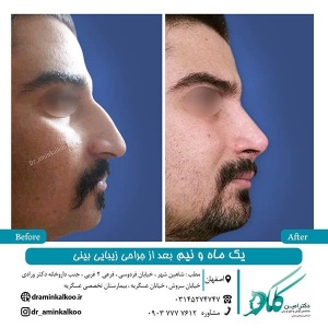 جراحی-بینی-اصفهان-12
