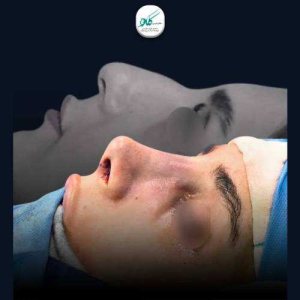 جراحی-بینی-136