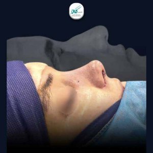 جراحی-بینی-137