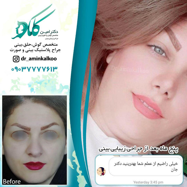 اقدامات قبل از جراحی بینی - دکتر امین کلکو