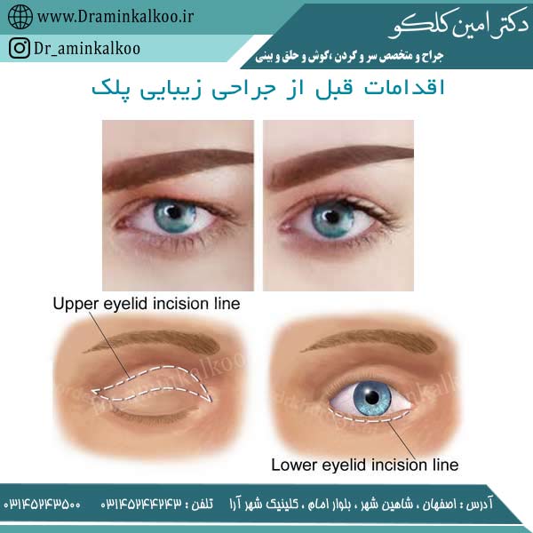 اقدامات قبل از جراحی زیبایی پلک