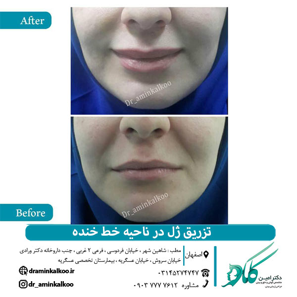عکس قبل و بعد تزریق ژل و بوتاکس - دکتر امین کلکو