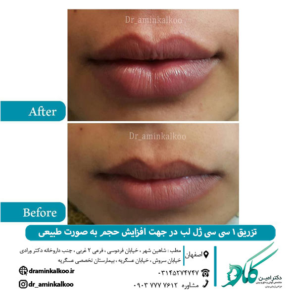 عکس قبل و بعد تزریق ژل لب و بوتاکس - دکتر امین کلکو