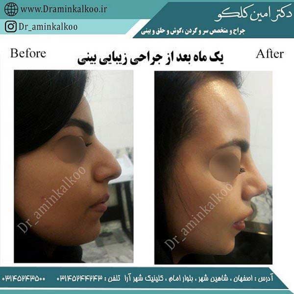 عکس قبل و بعد جراحی بینی-دکتر کلکو