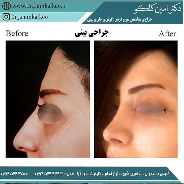 جراحی بینی 2