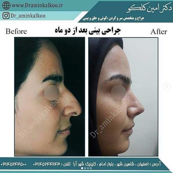 جراحی بینی-دکتر کلکو