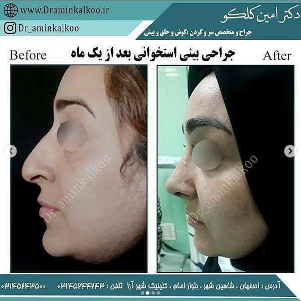 جراحی بینی-دکتر کلکو
