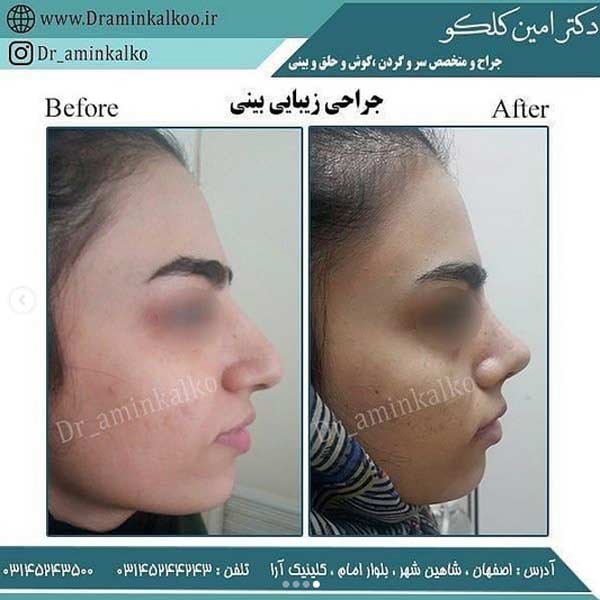 عکس جراحی بینی-دکتر کلکو