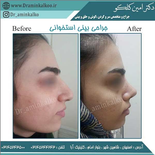 عکس قبل و بعد جراحی بینی استخوانی