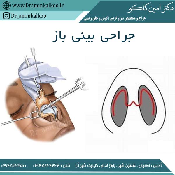 جراحی بینی باز
