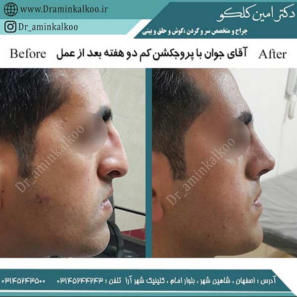عکس قبل و بعد جراحی بینی طبیعی