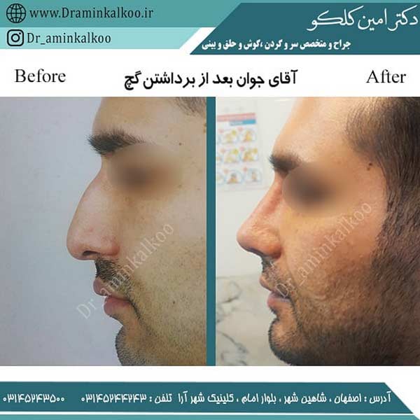 عکس قبل و بعد جراحی بینی طبیعی - دکتر کلکو