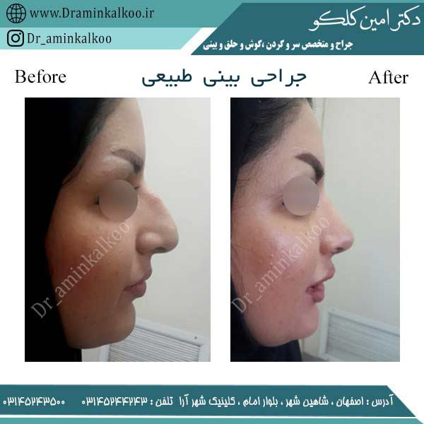 عکس قبل و بعد جراحی بینی طبیعی - دکتر امین کلکو