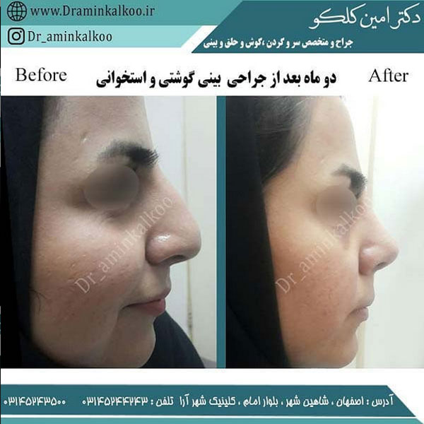 عکس قبل و بعد جراحی بینی گوشتی