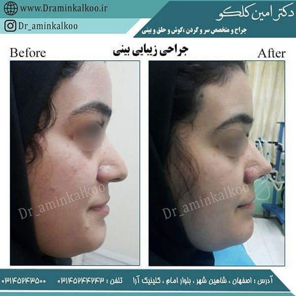 جراحی بینی گوشتی