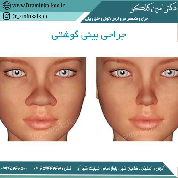جراحی بینی گوشتی