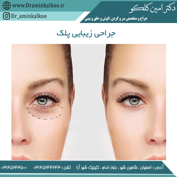 جراحی زیبایی پلک