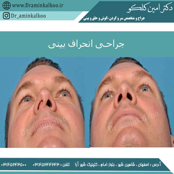 جراحی انحراف بینی - دکتر امین کلکو