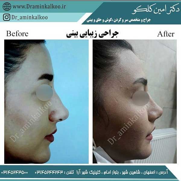 جراحی بینی در اصفهان