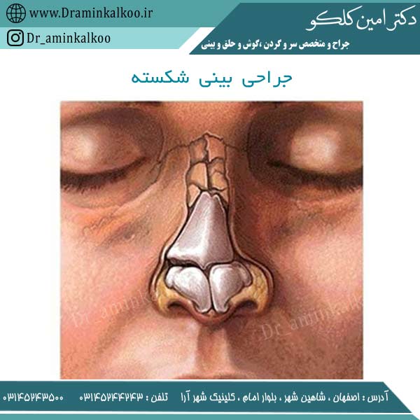 جراحی بینی شکسته
