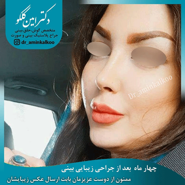 عکس جراحی بینی بهترین جراح بینی اصفهان