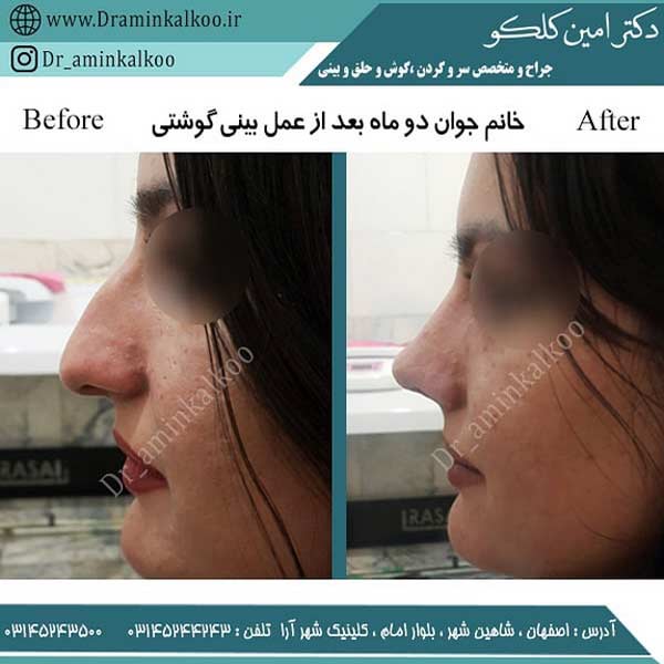 جراحی بینی-دکتر کلکو