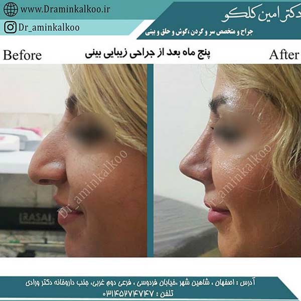 عکس جراحی بینی استخوانی