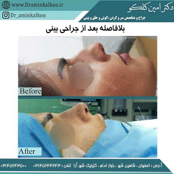 عکس جراحی بینی استخوانی