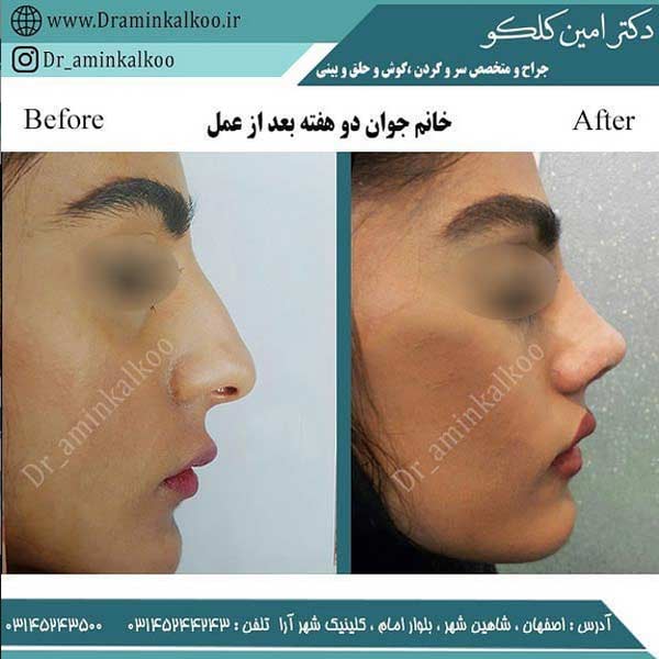 عکس قبل و بعد جراحی بینی استخوانی