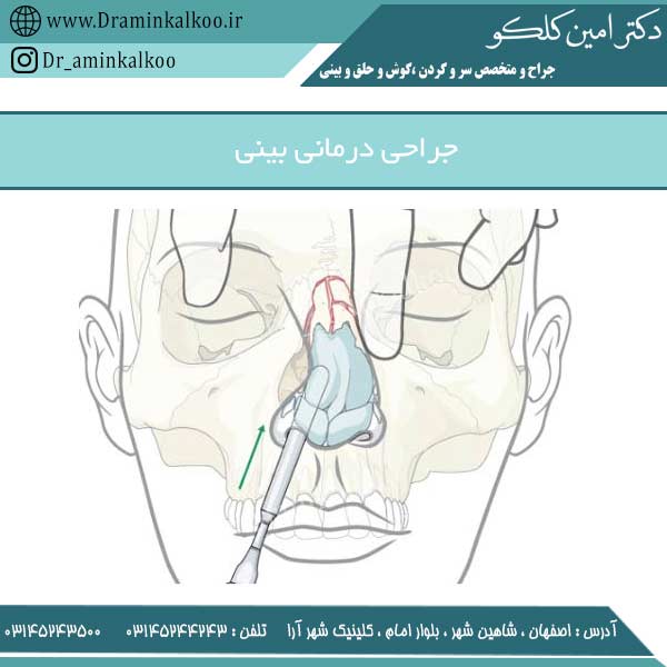 عکس جراحی درمانی بینی
