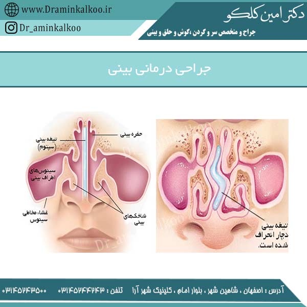 جراحی درمانی بینی