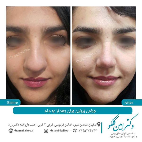 عکس قبل و بعد جراحی بینی گوشتی
