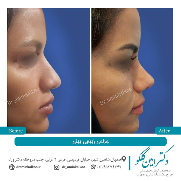 عکس قبل و بعد جراحی بینی گوشتی