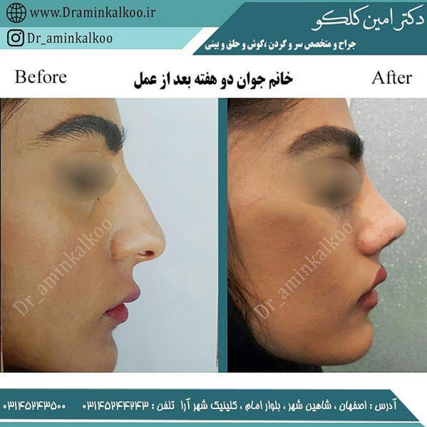 جراحی کردن بینی