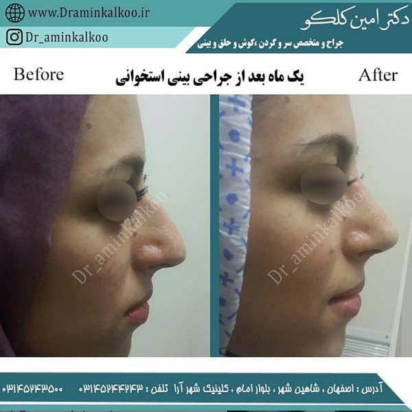 جراحی بینی- دکتر کلکو