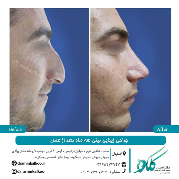 عکس قبل و بعد جراحی بینی استخوانی