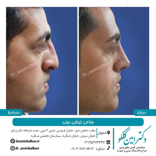 جراحی زیبایی بینی
