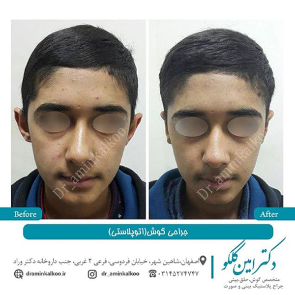 عکس قبل و بعد جراحی گوش- دکتر کلکو