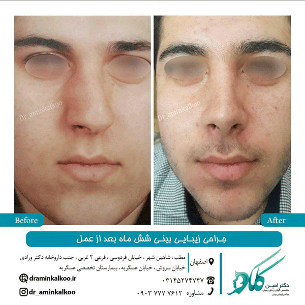 عکس جراحی بینی کج - شش ماه بعد عمل - دکتر امین کلکو