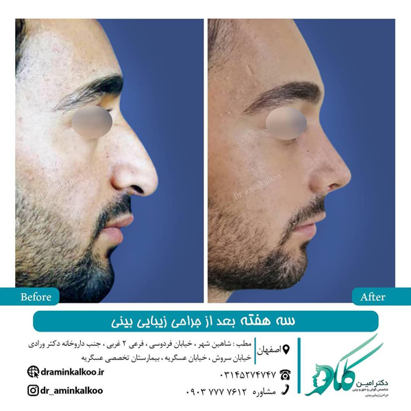مراقبت های بعد از جراحی بینی