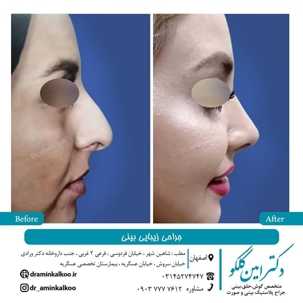 عکس نمونه کار جراحی بینی - مراقبت های بعد از جراحی بینی - دکتر امین کلکو