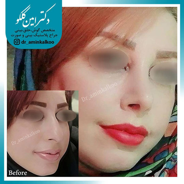 عکس قبل و بعد جراحی زیبایی بینی