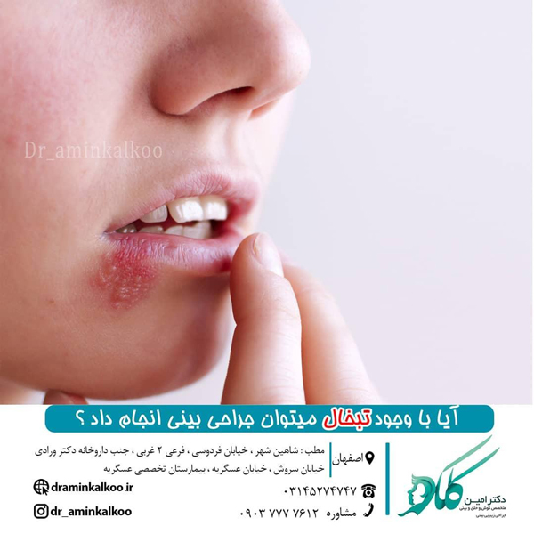 تبخال و عمل بینی