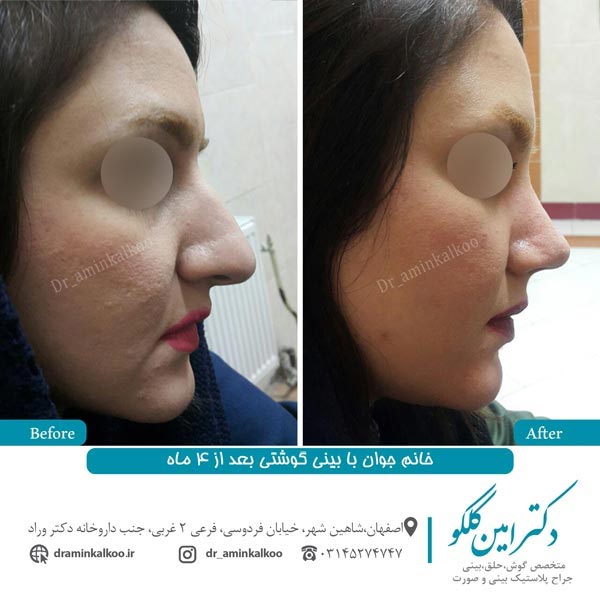 عکس قبل و بعد جراحی بینی گوشتی