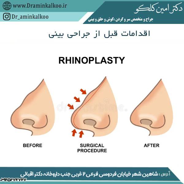 اقدامات قبل از جراحی بینی - دکتر امین کلکو