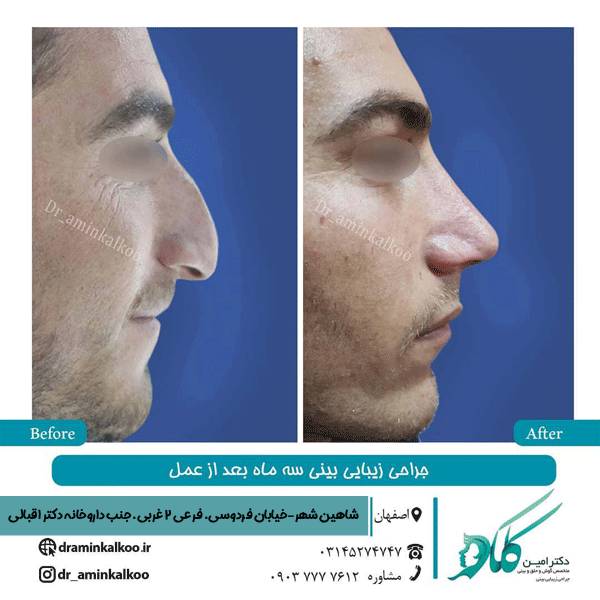 بهترین جراح بینی اصفهان - دکتر امین کلکو