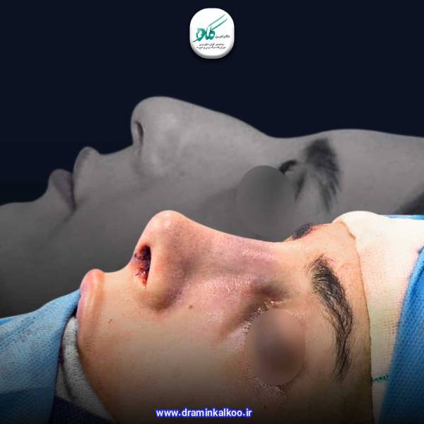 جراحی بینی در مردان - دکتر امین کلکو