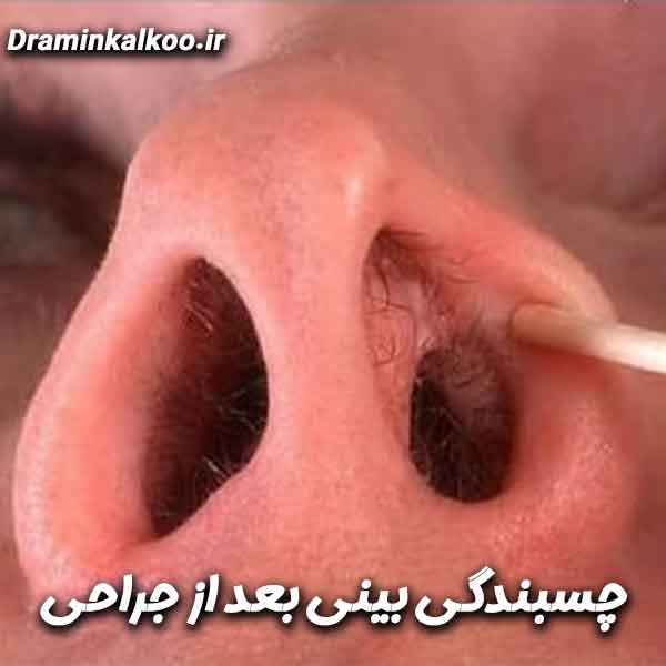 چسبندگی بینی بعد از جراحی