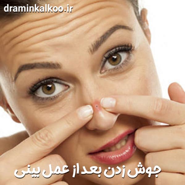 جوش زدن بعد از عمل بینی
